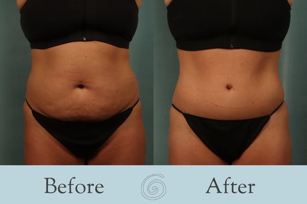 Tummy Tuck Before and After 39 - Front