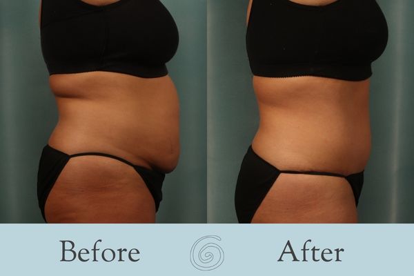 Tummy Tuck Before and After 39 - Side