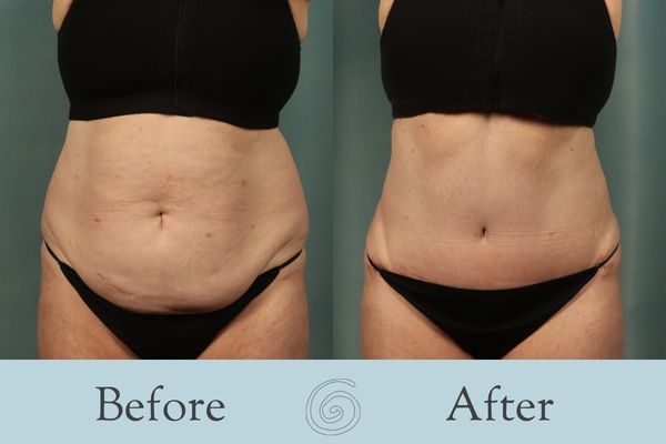 Tummy Tuck Before and After 40 - Front