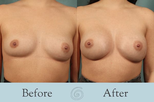 Breast Augmentation Before and After 19 _ Front