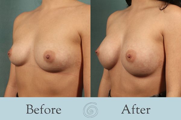Breast Augmentation Before and After 19 _ Side