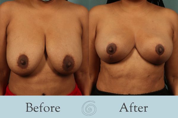Breast Reduction Before and After 28 - Front