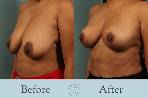 Breast Reduction Before and After 28 - Side