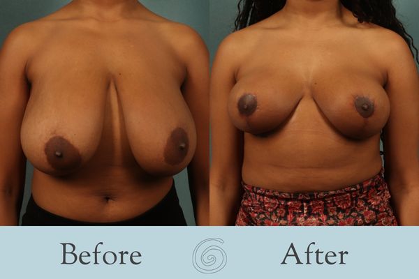 Breast Reduction Before and After 29 - Front