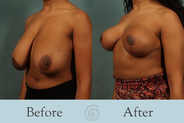 Breast Reduction Before and After 29 - Side