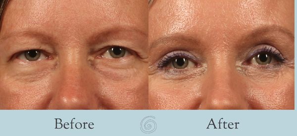 Eyelid Surgery Before and After 32 - Front