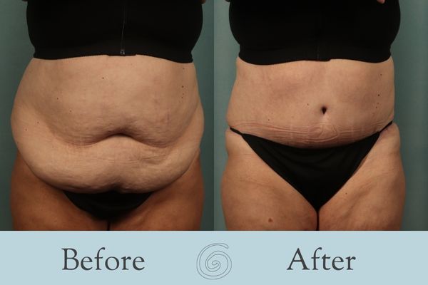 Tummy Tuck Before and After 41 - Front