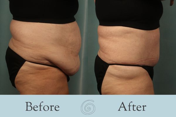 Tummy Tuck Before and After 41 - Side