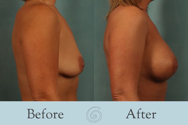 Breast Augmentation Before and After 20 - Side