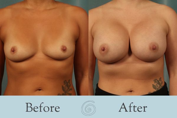 Breast Augmentation Before and After 34 - Front