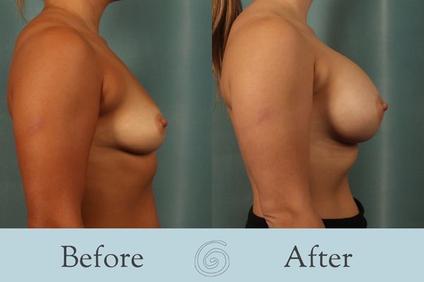 Breast Augmentation Before and After 34 - Side