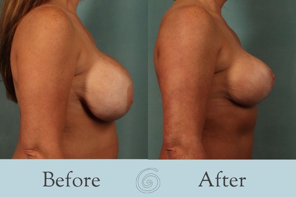 Breast Augmentation and Lift Before and After 23 _ Side