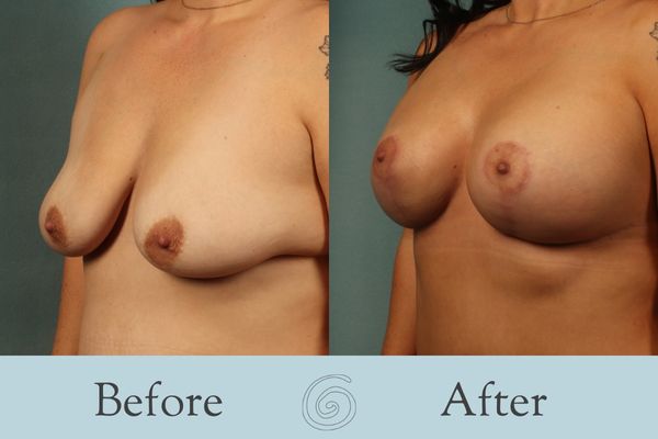 Breast Augmentation and Lift Before and After 24 _ Side
