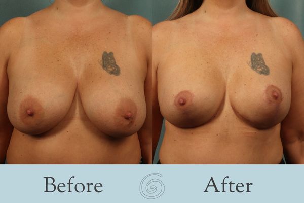 Breast Augmentation and Lift Before and After 25 _ Front