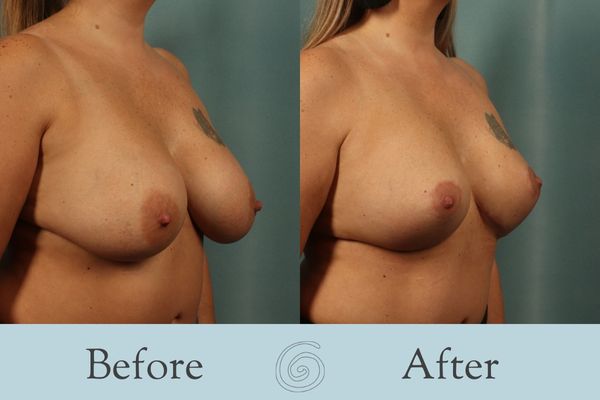 Breast Augmentation and Lift Before and After 25 _ Side