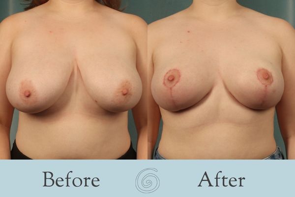 Breast Reduction Before and After 30 - Front