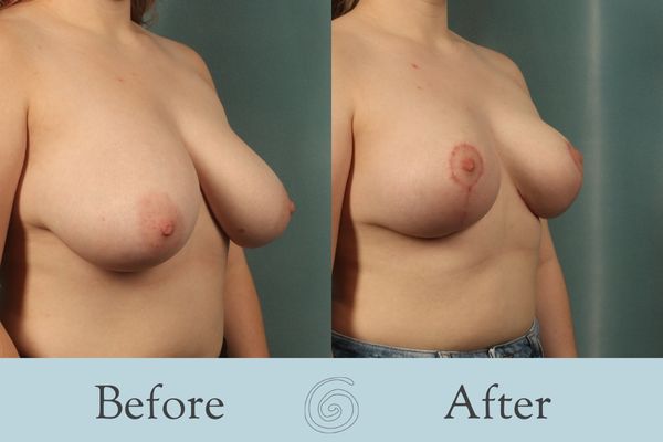Breast Reduction Before and After 30 - Side