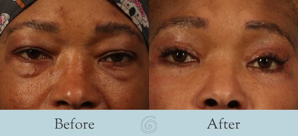 Eyelid Surgery Before and After 33 - Front