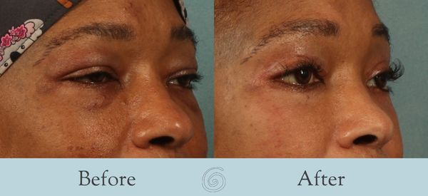 Eyelid Surgery Before and After 33 - Side