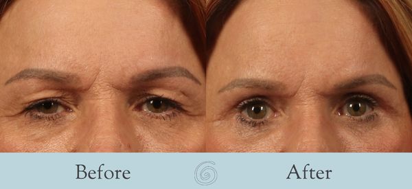 Eyelid Surgery Before and After 34 - Front