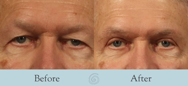 Eyelid Surgery Before and After 35 - Front