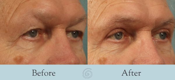 Eyelid Surgery Before and After 35 - Side