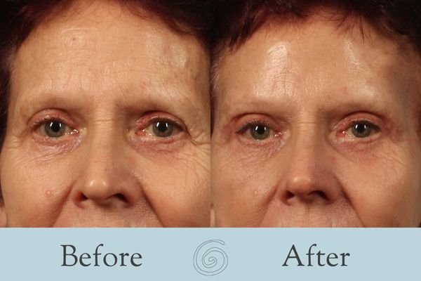 Facelift Before and After 17 _ Front