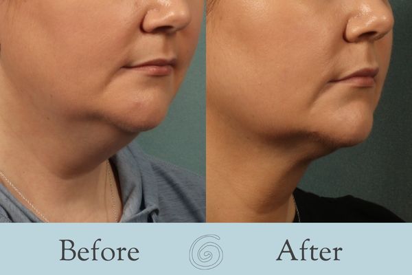 Liposuction Before and After 20 - Front