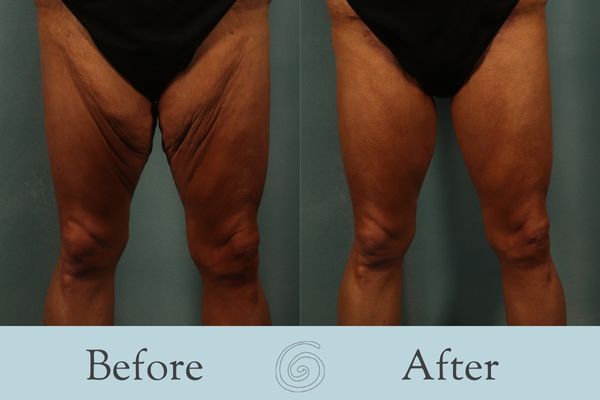 Thigh Lift Before and After 1