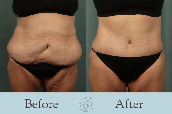 Tummy Tuck Before and After 42 - Front