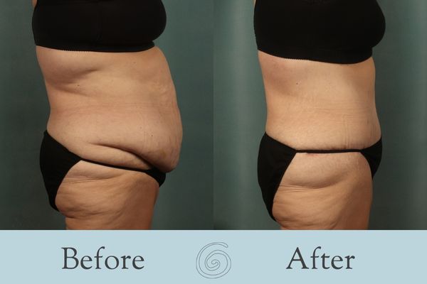 Tummy Tuck Before and After 42 - Side