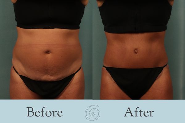 Tummy Tuck Before and After 43 - Front