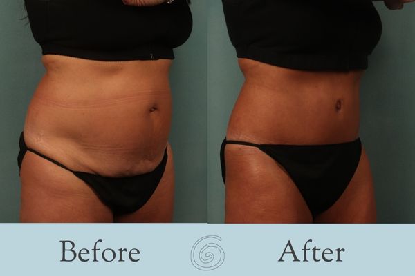 Tummy Tuck Before and After 43 - Side