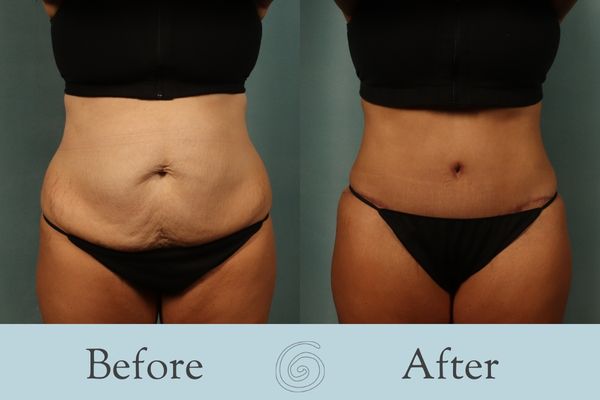 Tummy Tuck Before and After 44 - Front