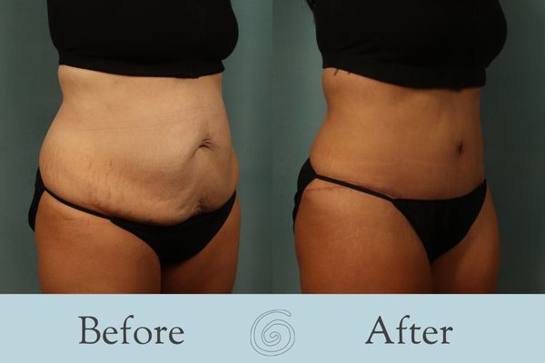 Tummy Tuck Before and After 44 - Side
