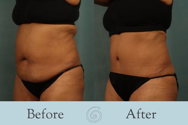 Tummy Tuck Before and After 45 - Side