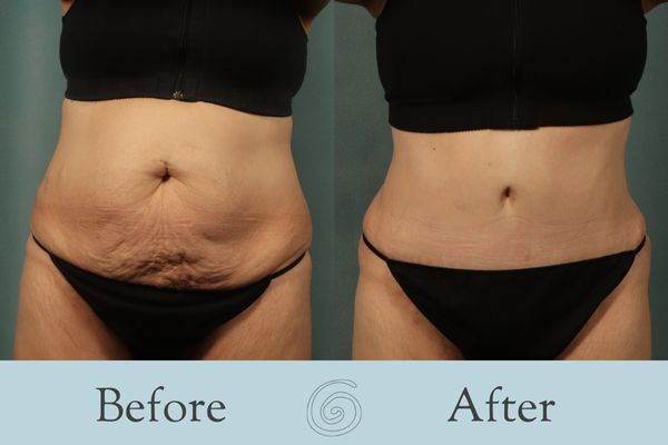 Tummy Tuck Before and After 46 - Front