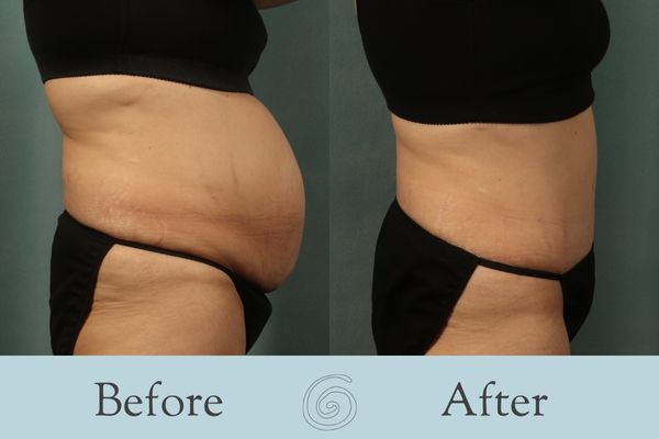 Tummy Tuck Before and After 46 - Side