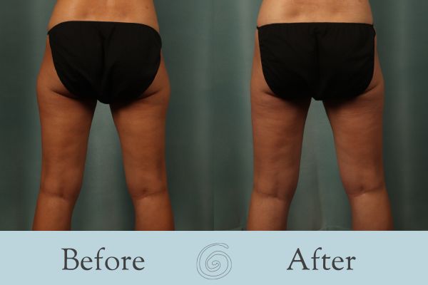 Liposuction Before and After 21 - Back