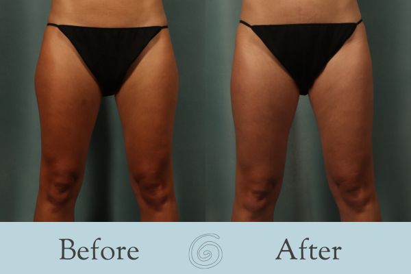Liposuction Before and After 21 - Front
