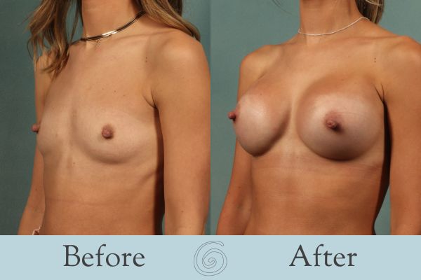 Breast Augmentation Before and After 35 - Side