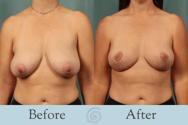 Breast Lift Before and After 11 - Front