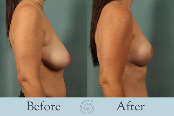 Breast Lift Before and After 11 - Side