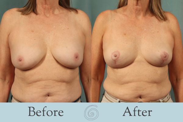 Breast Lift Before and After 12 - Front