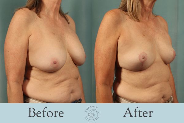 Breast Lift Before and After 12 - Side