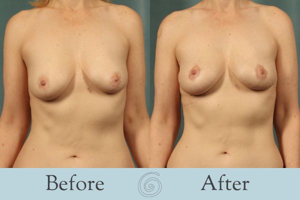 Breast Lift Before and After 13 - Front