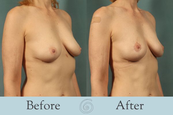 Breast Lift Before and After 13 - Side