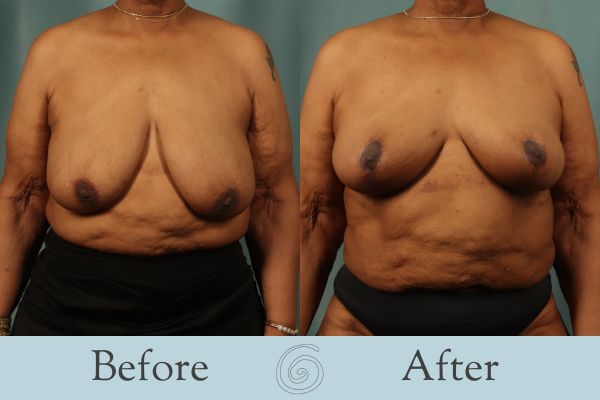 Breast Reduction Before and After 31 - Front