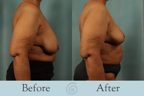 Breast Reduction Before and After 31 - Side