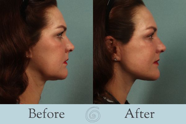 Facelift Before and After 19 - Side